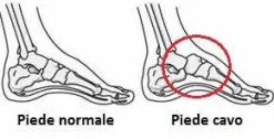 Solette Plantari per Correzione Piede Cavo - Scarpe Uomo e Donna