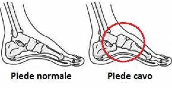 Solette Plantari per Correzione Piede Cavo - Scarpe Uomo e Donna